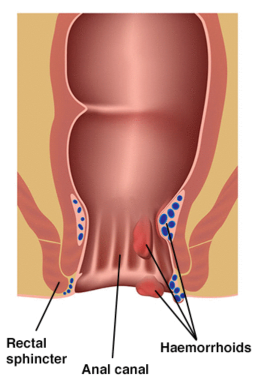 Haemorrhoid diagram