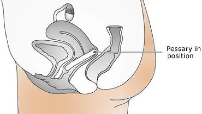 Vaginal pessary in advanced pelvic organ prolapse: impact on quality of  life | International Urogynecology Journal