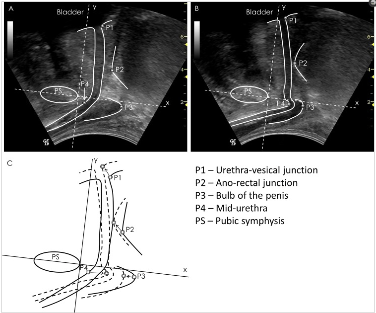 Male Transperineal